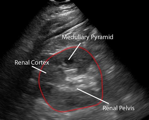 Normal renal tract ultrasound (female) .